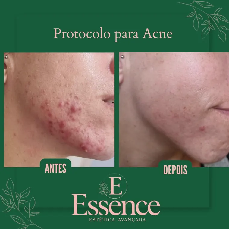 Antes e depois do protocolo para acne na Essence em Niterói