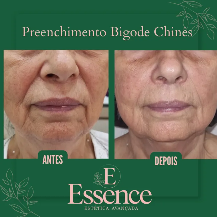Antes e depois de preenchimento do bigode chinês na Essence