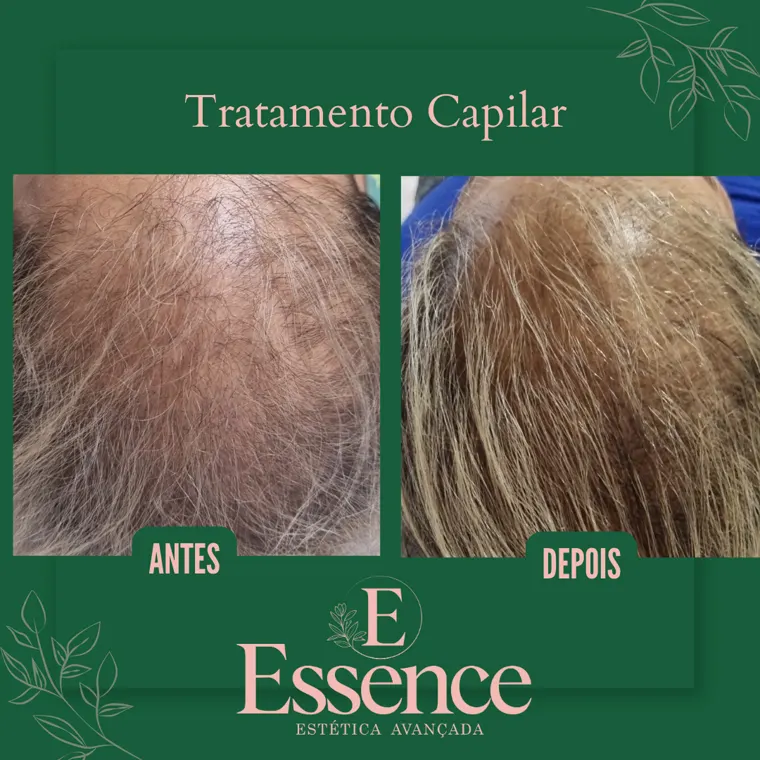 Antes e depois de tratamento capilar na Essence em Niterói