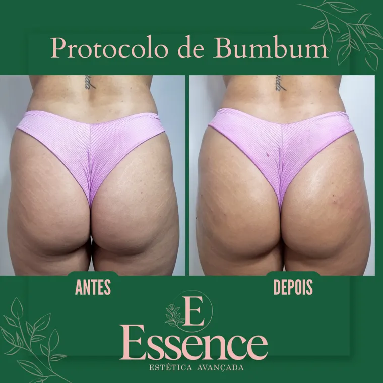 Antes e depois do protocolo de glúteos na Essence em Niterói