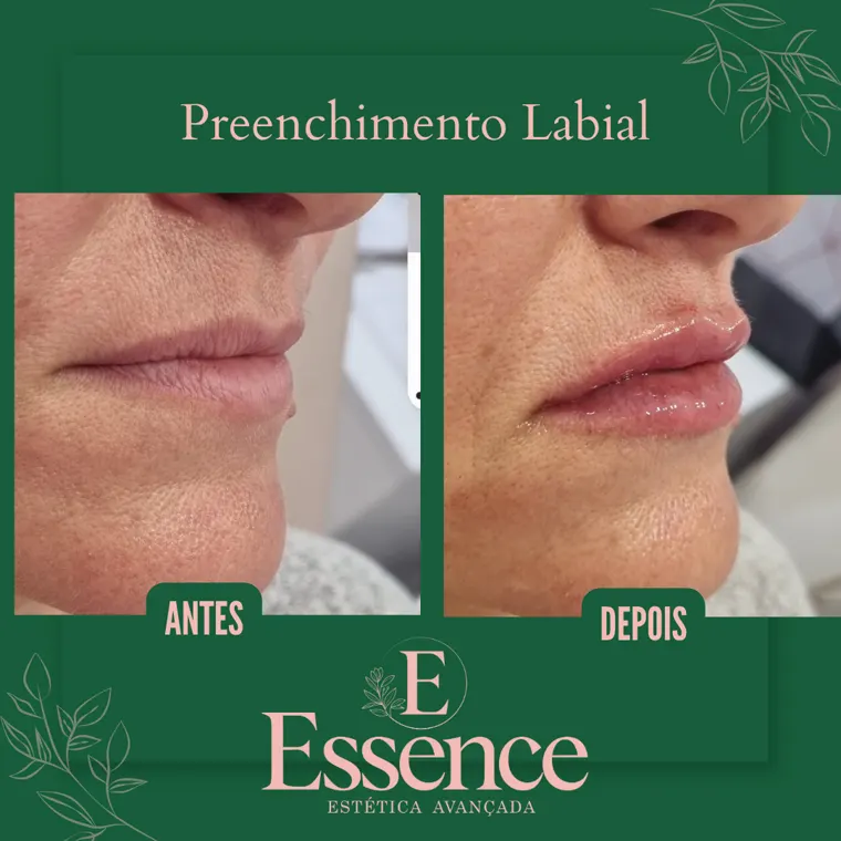 Antes e depois de preenchimento labial na Essence em Niterói