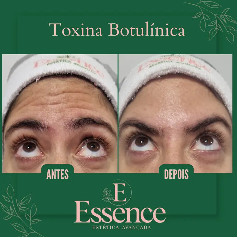 Antes e depois de toxina botulínica na Essence em Niterói